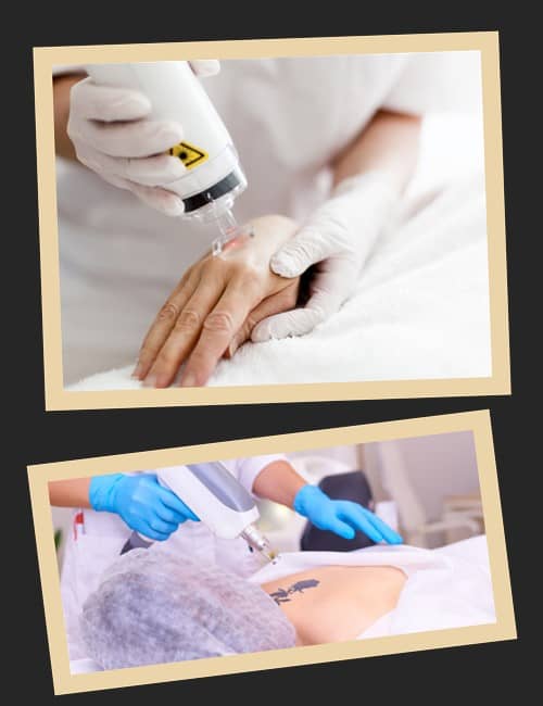 Як можна видалити татуювання