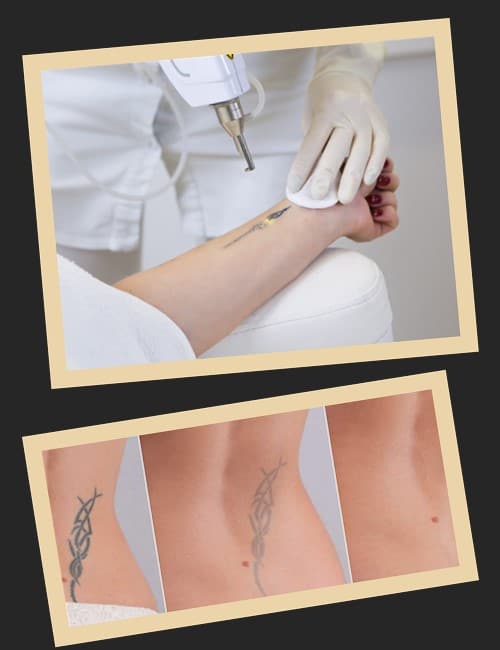 видалення тату