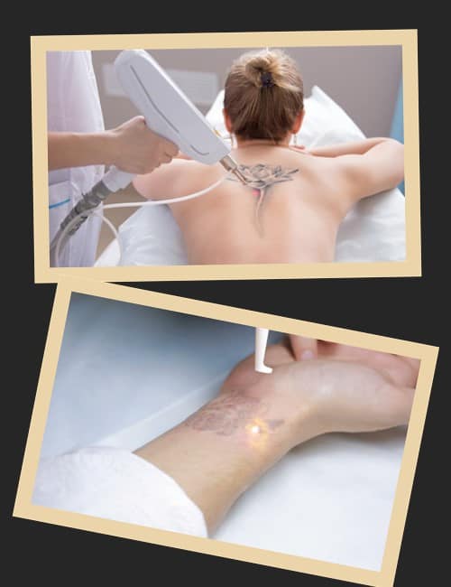 Як звести татуювання