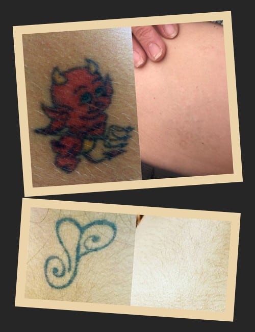 Видалення татуювань у Києві