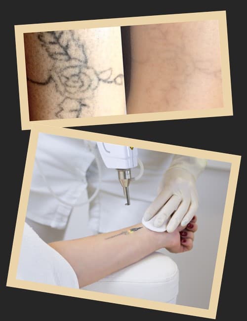 позбавитися непотрібного тату