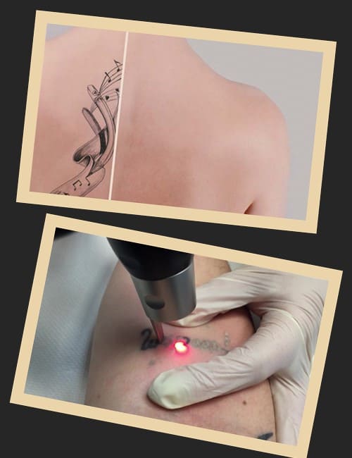 Чому лазерне видалення тату – найкраще