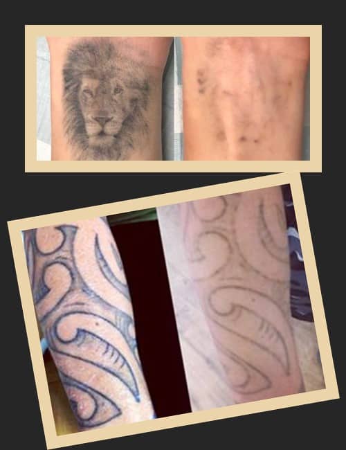 способи видалення тату