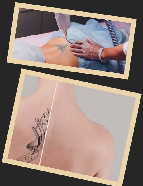 звести тату в Києві