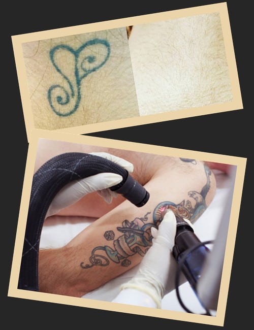 позбутися старого татуювання