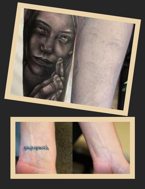 кращий метод видалення тату