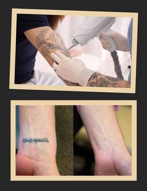 Швидкість виведення татуювання