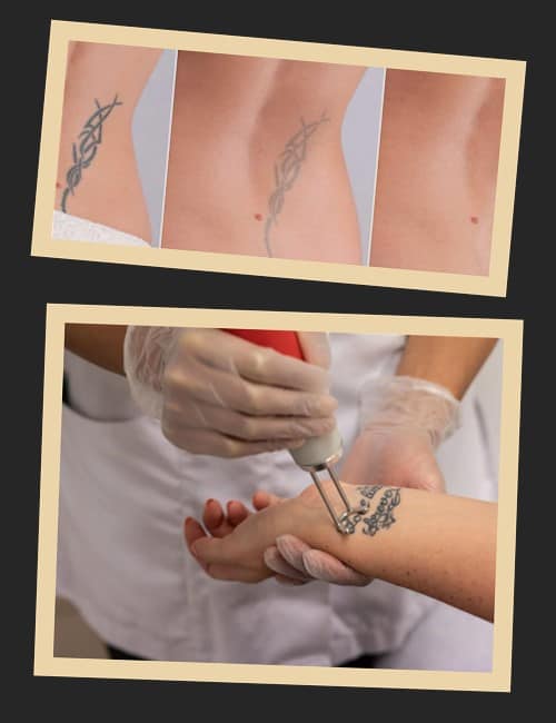 Зведення тату лазером