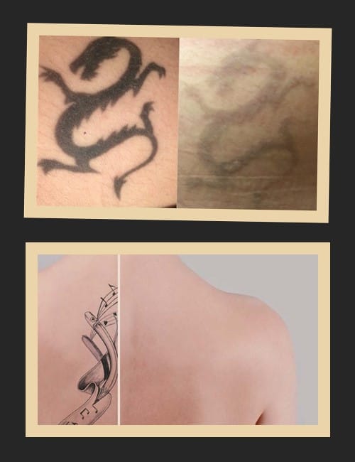 спосіб позбутися татуювання