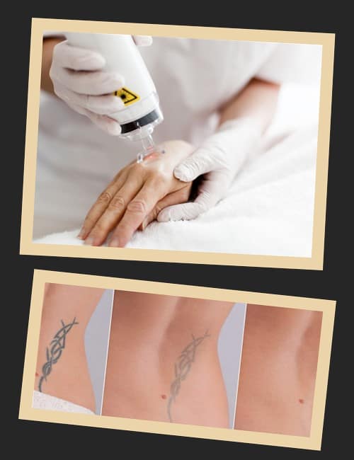 Звести тату в Києві якісно