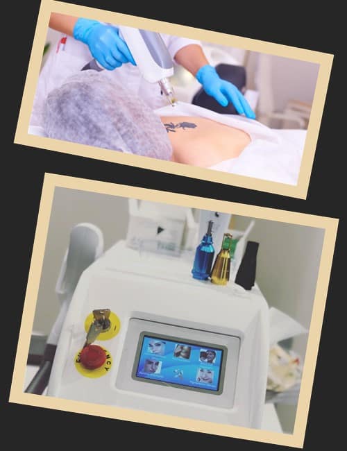 Зведення татуювань лазером