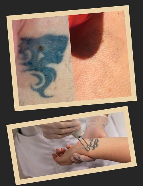 догляд за шкірою пысля видалення тату