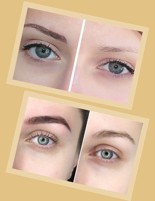 Лазерне виведення татуажу брів