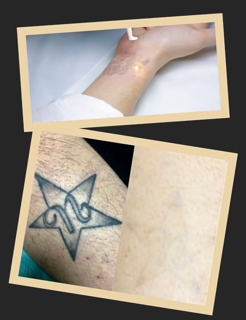 Як виконується лазерне видалення тату