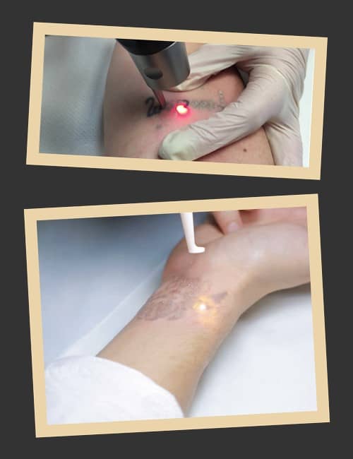 Принцип роботи лазерних апаратів