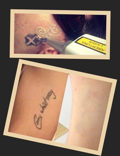 Лазерний метод – надійний спосіб позбутися татуювання