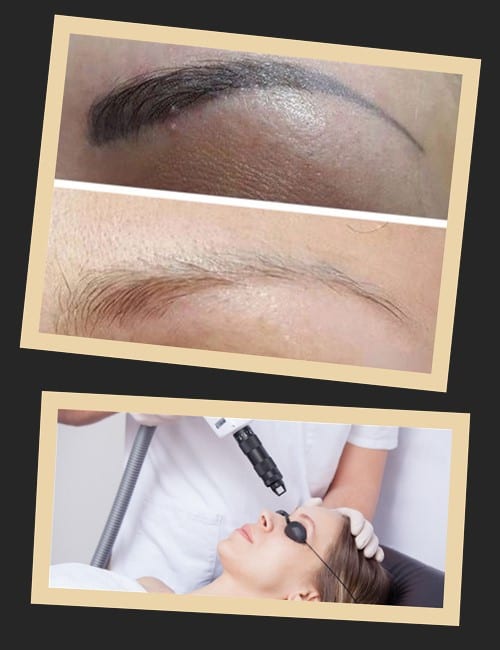 Які методи видалення татуажу безпечні