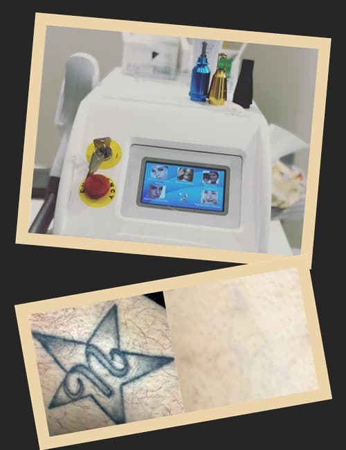 Виведення тату лазером