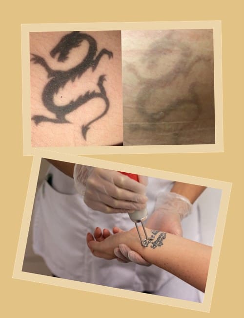 Лазерний метод виведення татуювань