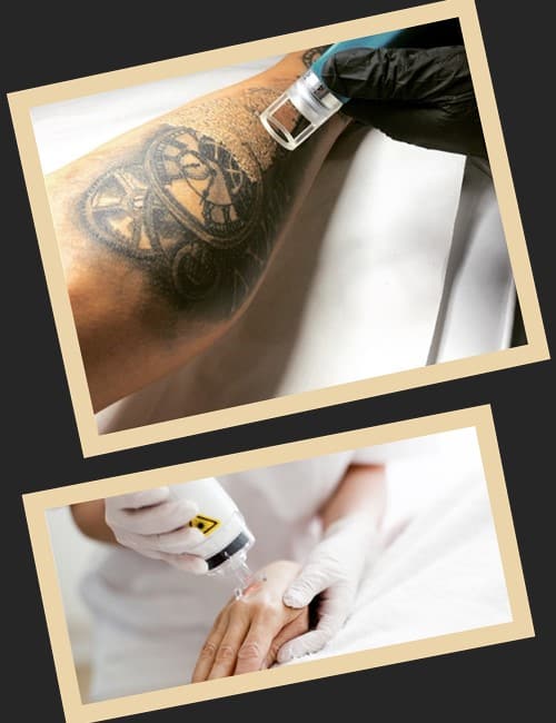 видалити татуювання лазером швидко