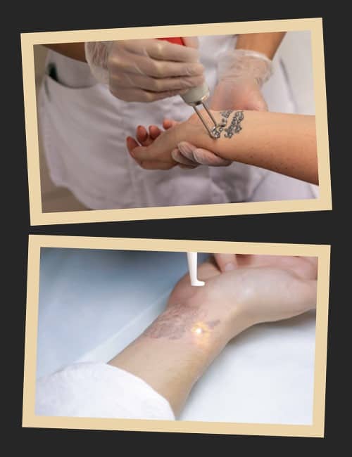 Способи видалення тату