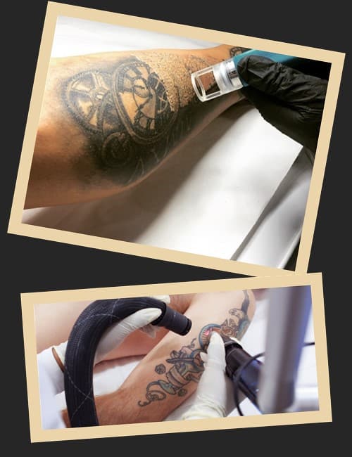 Переваги зведення татуювання лазером