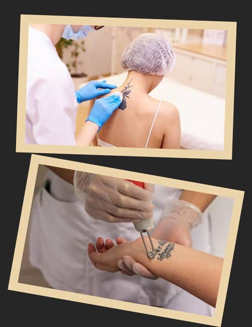 Лазерний метод для видалення тату