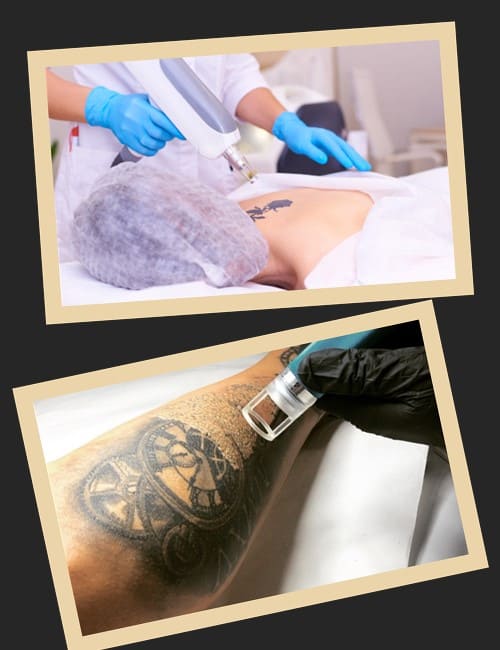 Особливості лазерного виведення тату