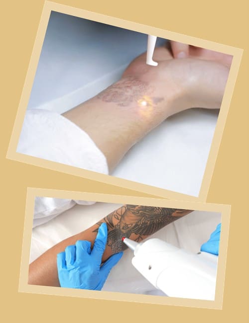 Основні способи видалення татуювань