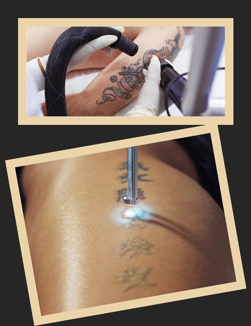 Догляд за шкірою після сеансу видалення тату