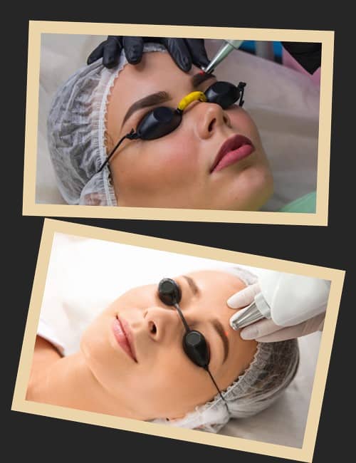 Принцип роботи лазера при видаленні татуажу