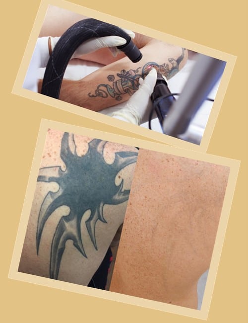 Як вивести татуювання