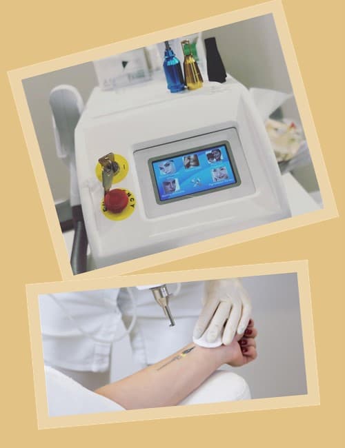 Як видаляють тату лазером