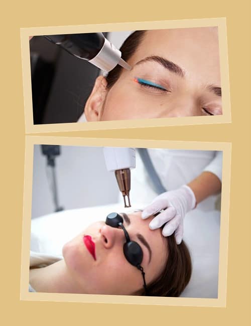 видалення татуажу