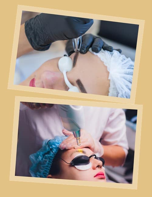 видалення татуажу лазером