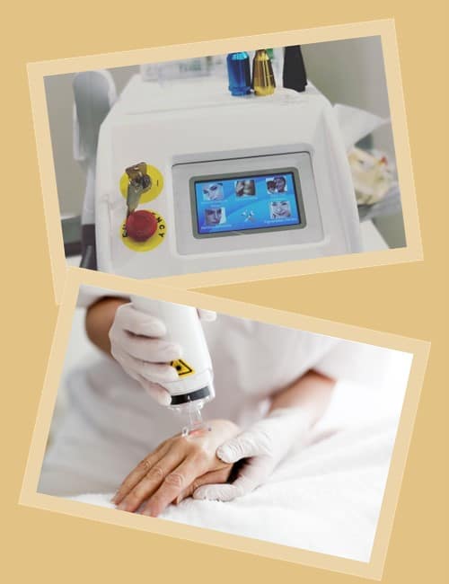 виводити тату лазером