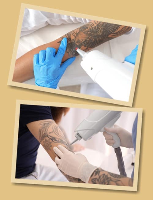 способи видалення татуювань