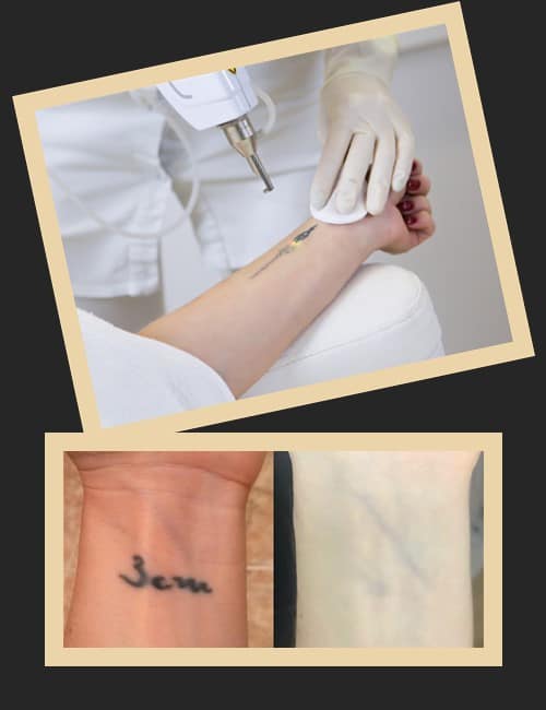 видалення татуювання