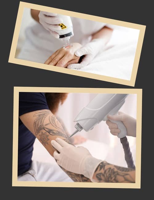 лазерні апарати для видалення татуювань