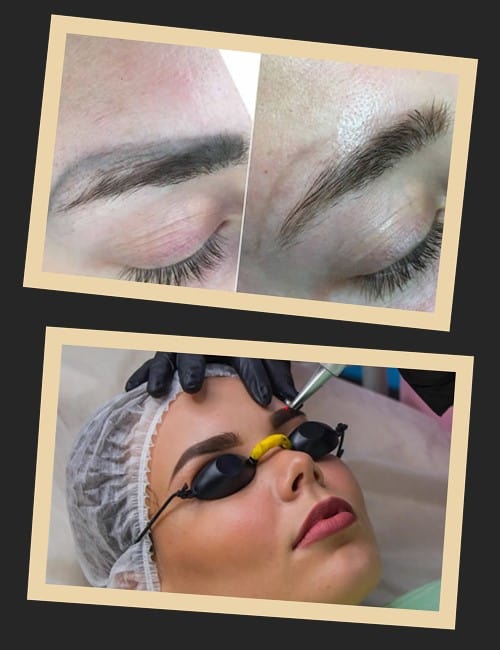 Чому найчастіше використовують лазер