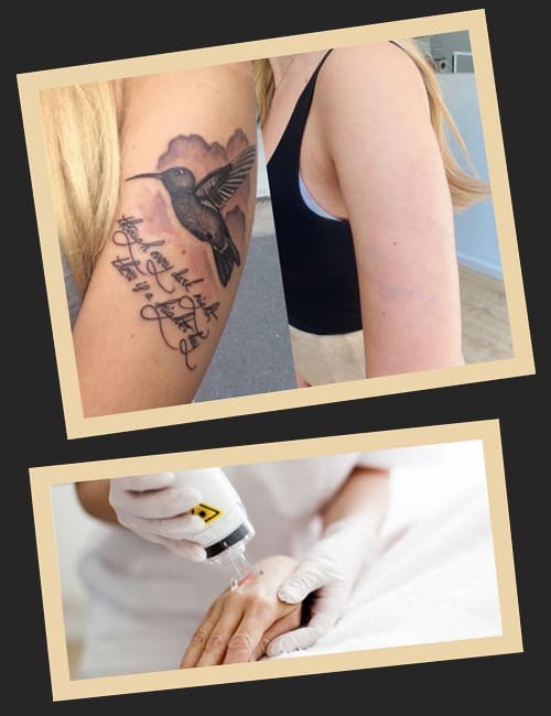 Чому видаляють татуювання