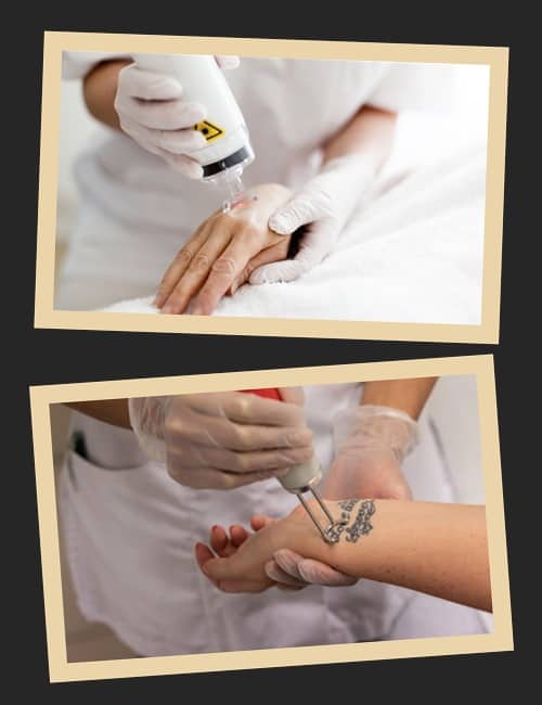 Особливості лазерного методу видалення тату