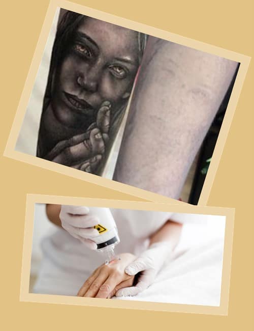 Виведення тату лазером