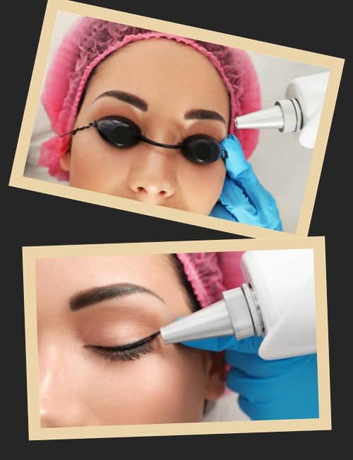 видалення татуажу лазером у салонах Києва