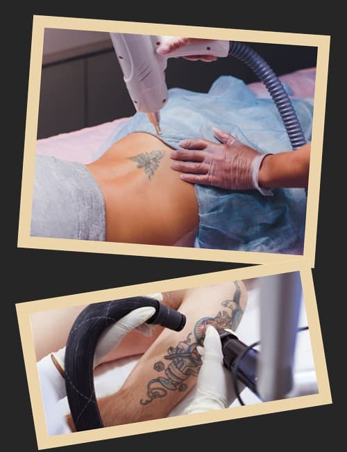 Переваги лазерного видалення тату