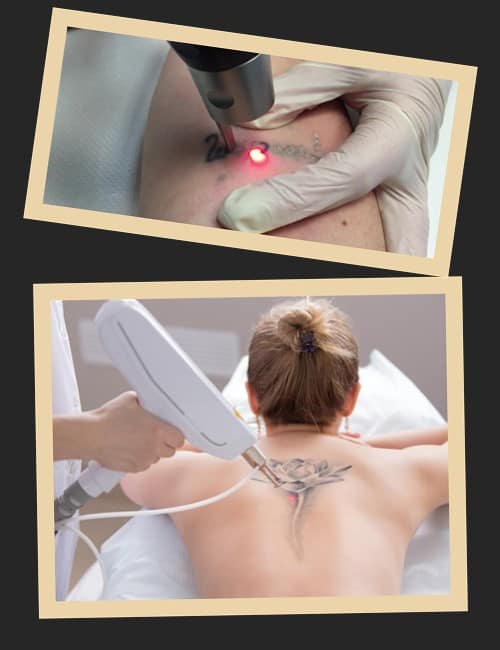 протипоказання лазерного видалення тату