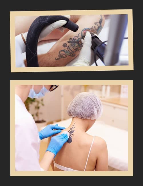 Сучасні лазерні апарати виводять тату