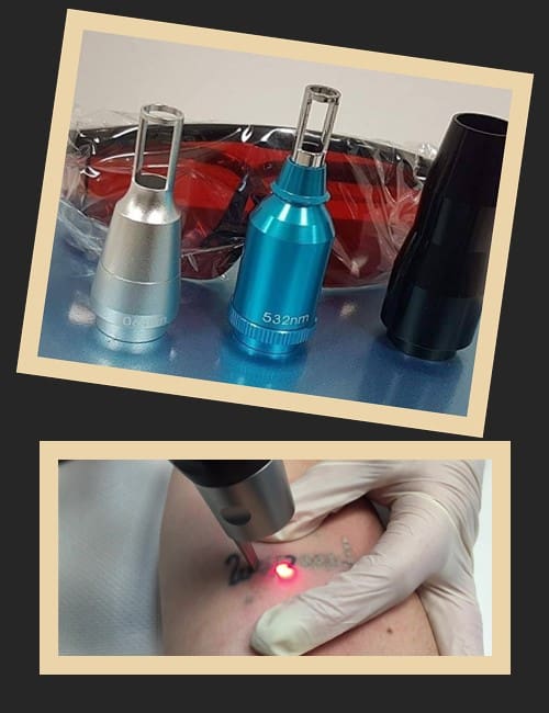 видалити тату лазером