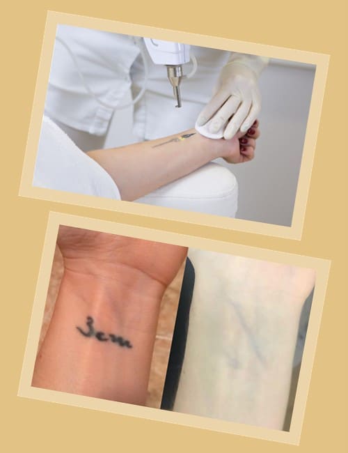 Найпрогресивнішими вважаються неодимовий лазер