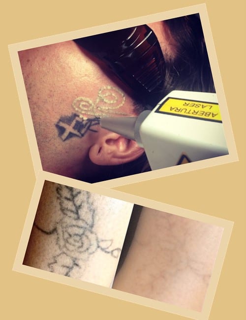 Переваги видалення тату лазером